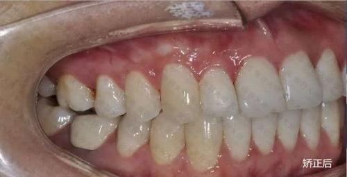 成人矫正不拔牙案例视频,不拔牙案例揭秘