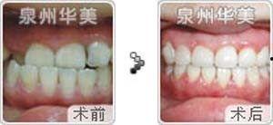 成人矫正不拔牙案例视频,不拔牙案例揭秘