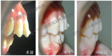 成人矫正不拔牙案例视频,不拔牙案例揭秘