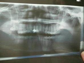 成人拔上层双层牙视频,专业操作与术后护理指南