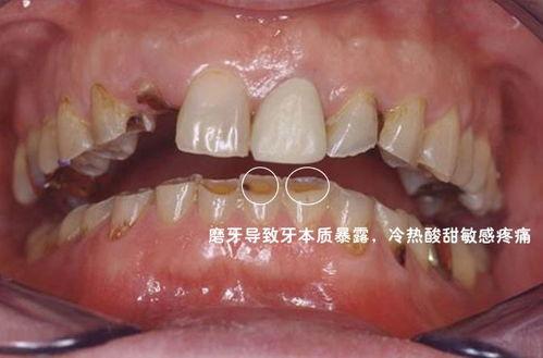 《磨牙》视频成人,成人磨牙现象的成因与应对策略  第2张